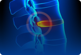 Abaulamento Discal